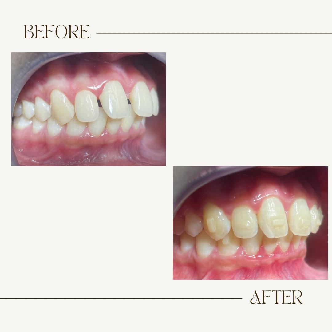 INVISALIGN PALLAVARAM