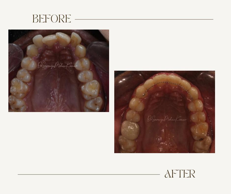 metal braces pallavaram