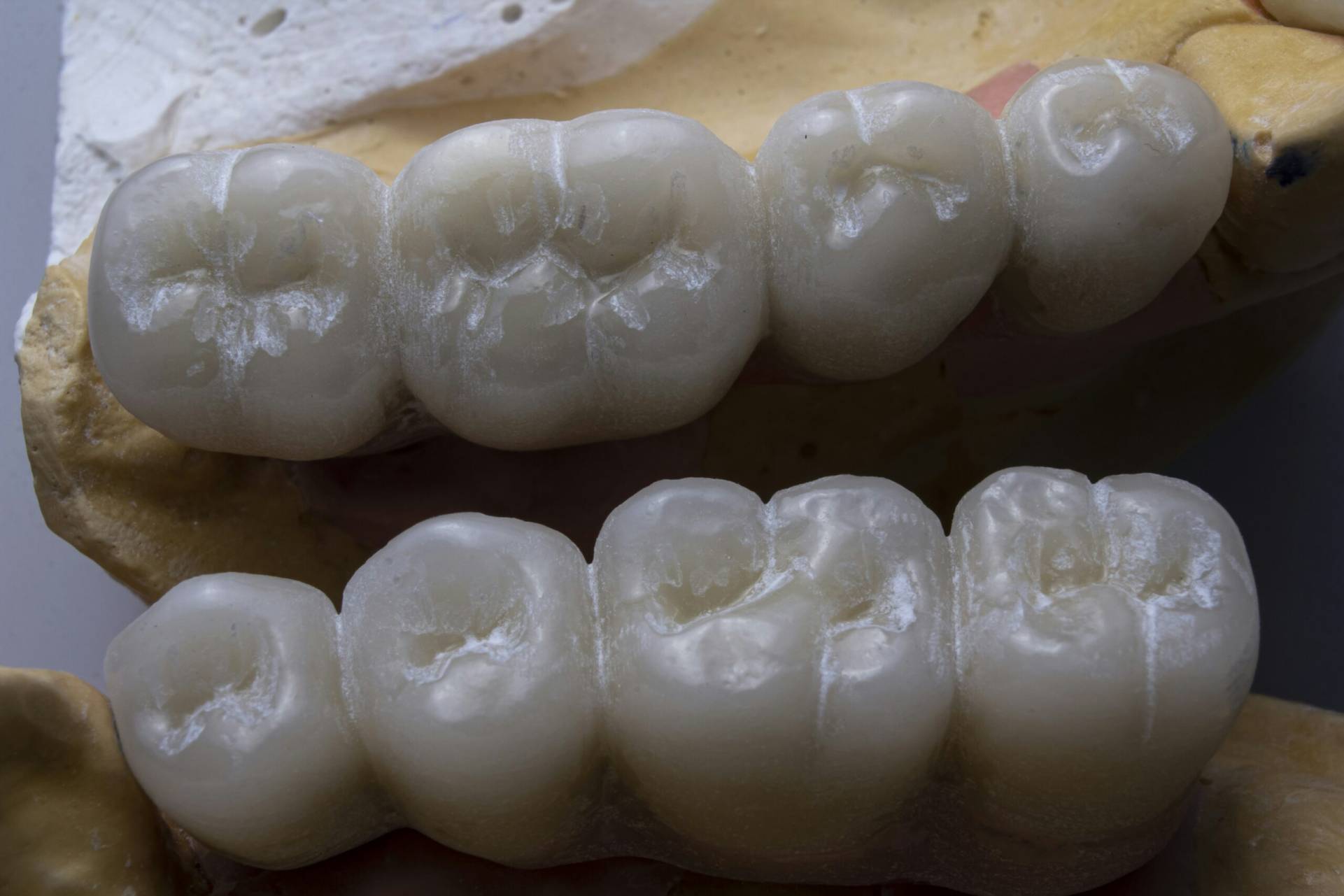Root Canal Treatment at Sowmya's Dental Clinic